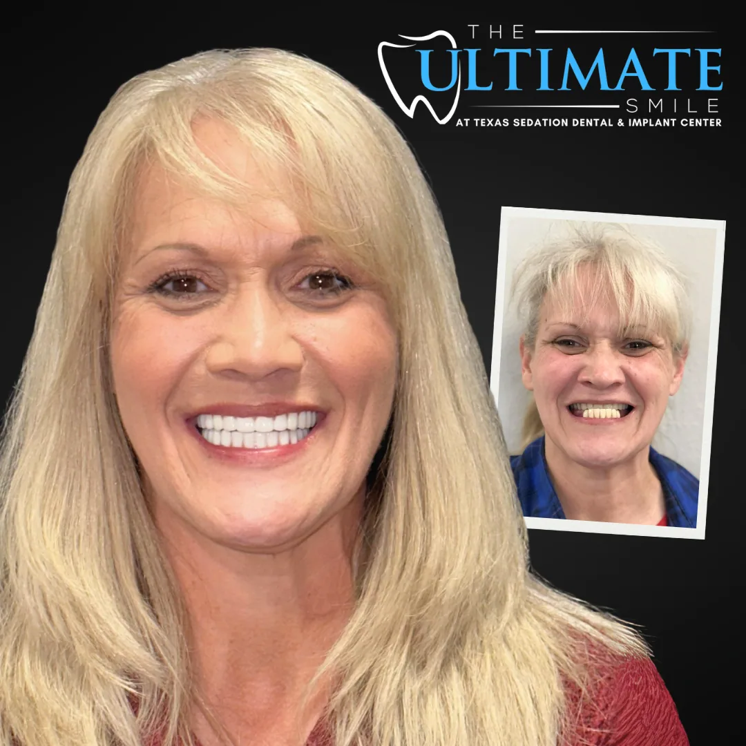 Before and after of an Ultimate Smile in 24 Hours full-arch implant restoration